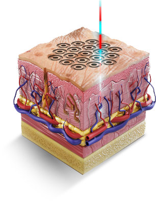High-Resolution-Skin-Resurfacing